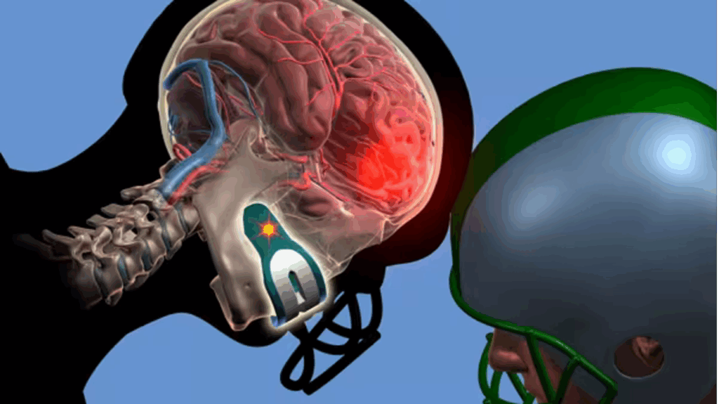 When Fit Matters: The Hidden Problem with Mouthguard Concussion Sensors